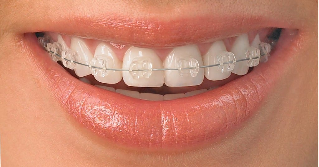 Ceramic_braces